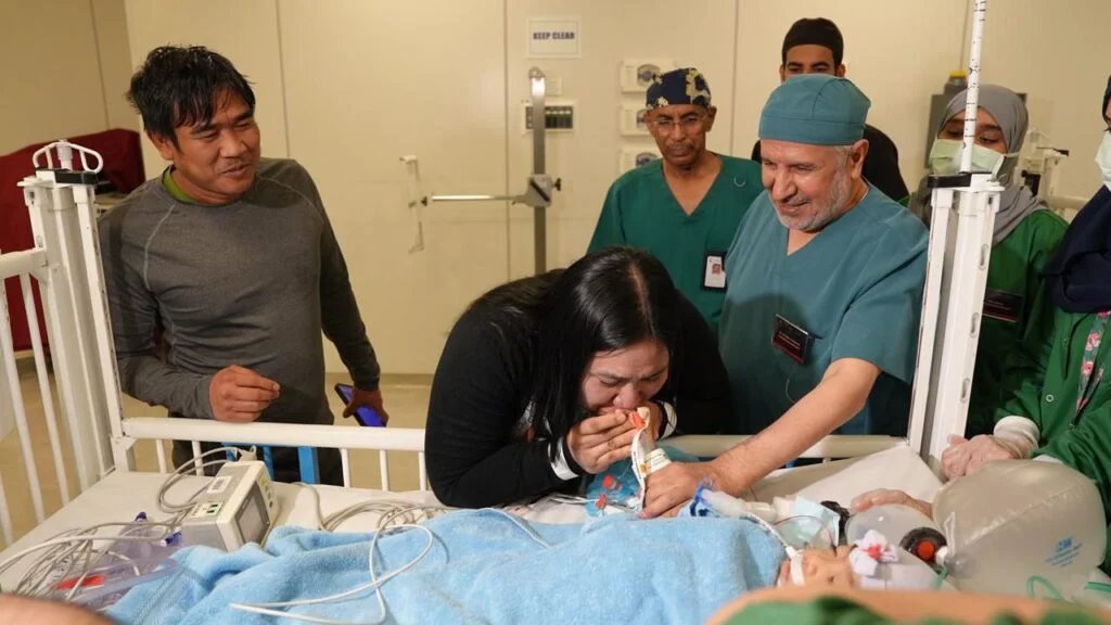 في إنجاز طبي جديد.. نجاح عملية فصل التوأم الملتصق الفلبيني (أوليفيا وجيانا) بعد 6 ساعات