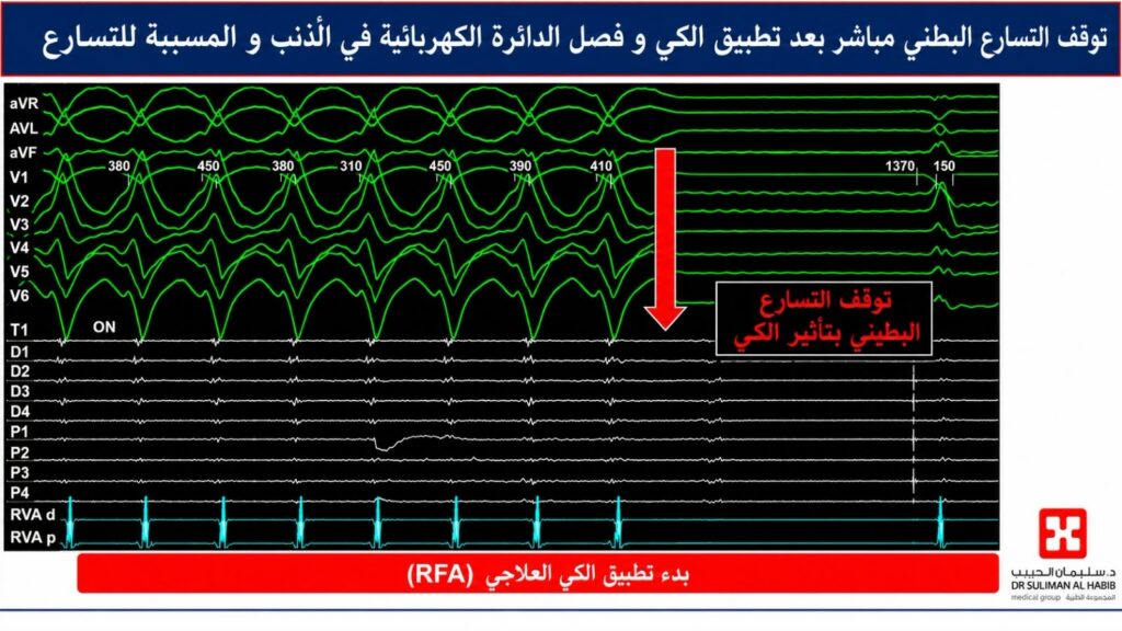 مستشفى الدكتور سليمان الحبيب بالصحافة يشهد أول استخدام لتقنية «المجال الكهربائي النبضي» لعلاج تسارع القلب البطيني الأيسر بالمملكة